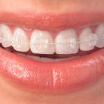 Clear Braces | Future Smiles Orthodontics Guam