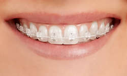 Self-Ligating Braces | Future Smiles Orthodontics Guam